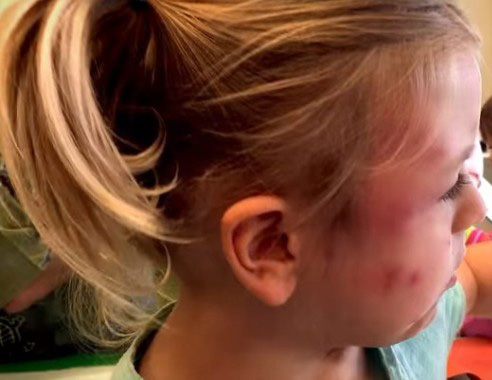 Младић (18) преминуо од МАЛИХ БОГИЊА; НИЈЕ БИО ВАКЦИНИСАН, лекари упиру прстом у АНТИВАКСЕРЕ – Puls Šumadije