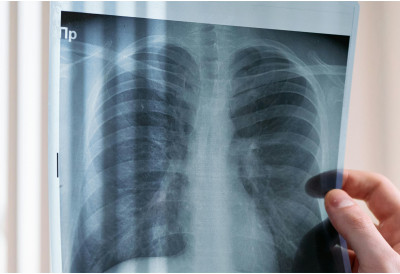 ПРЕВЕНТИВА ЈЕ ПОЛА ЗДРАВЉА У Сомбору бесплатан скрининг плућа