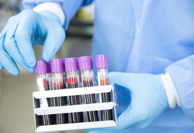 ТЕСТ ОТКРИВА БОЛЕСТИ ЧАК 10 ГОДИНА ПРЕ СИМПТОМА Биће могуће предвидети ризик од ДИЈАБЕТЕСА, СРЧАНИХ ОБОЉЕЊА, РАКА И ДЕМЕНЦИЈЕ