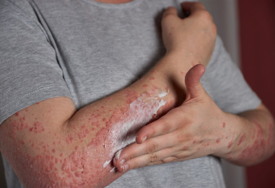 ЗАРАЗА ИЗ БИБЛИЈСКИХ ВРЕМЕНА ПОНОВО У РЕГИОНУ У Хрватској потврђен изолован случај губе, стручњаци смирују јавност