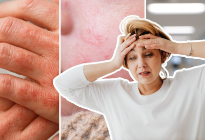 ЛЕПРА СЕ ВРАТИЛА! Заборављена болест поново куца на врата Европе ПРВИ СЛУЧАЈЕВИ ПОСЛЕ ДЕЦЕНИЈА УЗНЕМИРИЛИ РЕГИОН