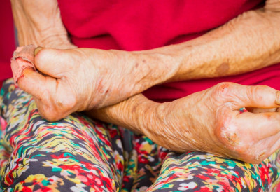 НЕМА РАЗЛОГА ЗА БРИГУ Лепре у Србији нема већ деценијама БОЛЕСТ СЕ ТЕШКО ПРЕНОСИ, А ЛАКО ЛЕЧИ