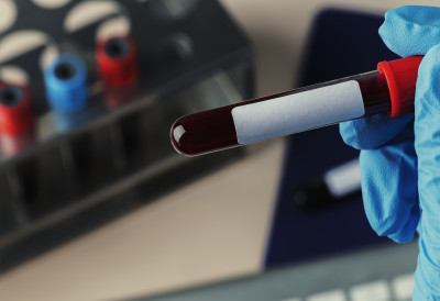 ЉУДИ СА ОВОМ КРВНОМ ГРУПОМ СУ У ВЕЋЕМ РИЗИКУ ОД ДОБИЈАЊА МОЖДАНОГ УДАРА Истраживање показало да су најугроженији млађи од 60 година