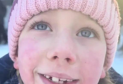 "НЕ МОГУ ЗАУВЕК ДА ЈЕ ДРЖИМ УМОТАНУ У ЋЕБЕ" Ханина ћерка има најређу алергију на свету! Када се игра на снегу изађе јој КОПРИВЊАЧА и ОТЕКНЕ КОЖА- Ово су сви симптоми