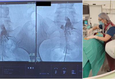 ЊИХ КИЧМА ВИШЕ НЕЋЕ БОЛЕТИ По први пут у УКЦВ изведена епидурална адхезиолиза РЕВОЛУЦИЈА У ЛЕЧЕЊУ ХРОНИЧНОГ БОЛА