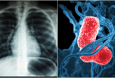 ОВО СУ СИМПТОМИ ОБОСТРАНЕ УПАЛЕ ПЛУЋА КОЈУ ИМА ИВИЦА ДАЧИЋ Ево када може доћи до компликација- Могу довести до ОТКАЗИВАЊА БУБРЕГА