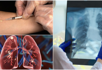 ТУБЕРКУЛОЗА НЕ ОДУСТАЈЕ Тиха болест и даље узима животе СРБИЈА НЕ СМЕ ДА СЕ ОПУСТИ