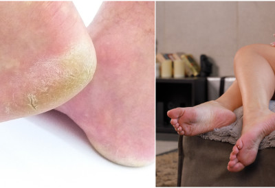 МЕЛЕМ ЗА ИСПУЦАЛЕ ПЕТЕ КОЈИ ПРАВИ ЧУДА Јефтин трик за савршено глатка стопала