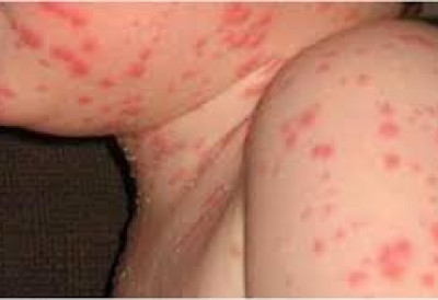 ЗЕМЉОМ СЕ ШИРИ ЕПИДЕМИЈА МАЛИХ БОГИЊА Покренута хитна кампања вакцинације усмерена на више од милион деце